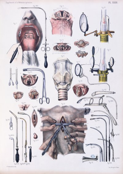 Tracheotomy Operation, Plate from 
